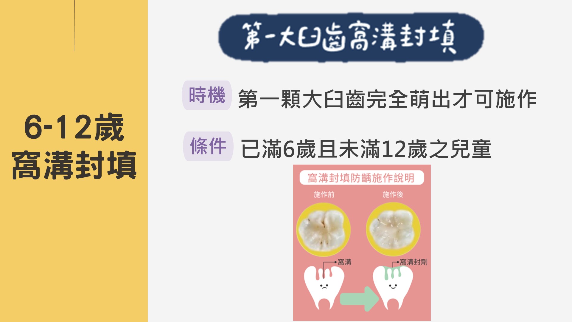 6-12歲 窩溝封填